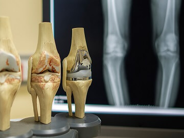 Hip Replacement Surgeon in Hyderabad